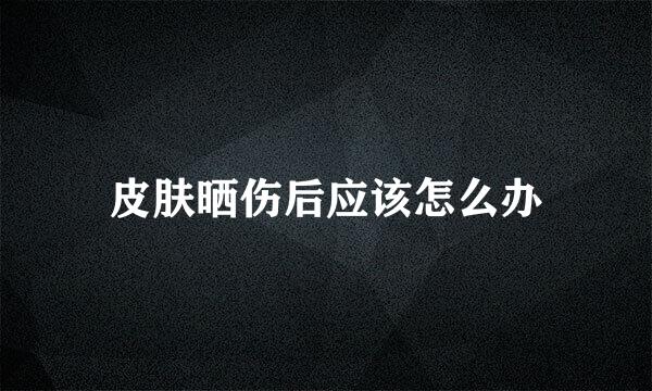 皮肤晒伤后应该怎么办