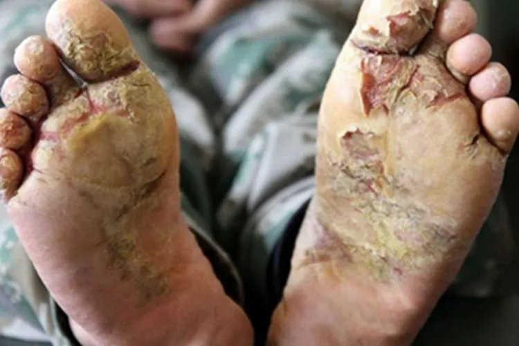 战壕足症状图片