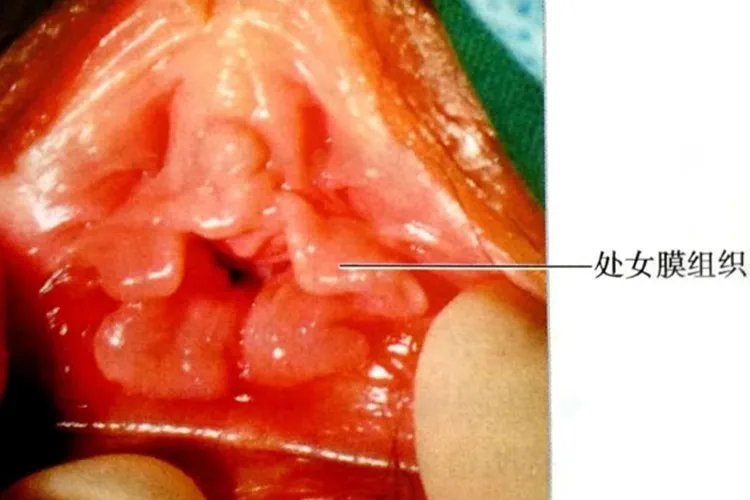 处女膜没有破裂和已经破裂真人对比图
