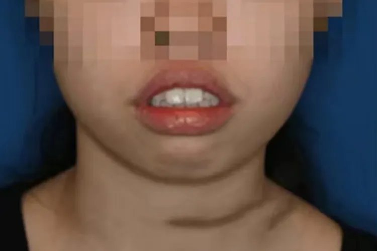 牙齿矫正图片效果图