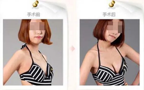 曼托隆胸价格多少钱