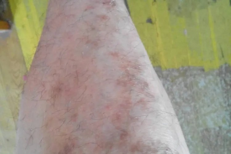 小腿湿疹图片和症状图片