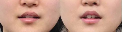 有名气的上海歪鼻矫正手术整形医院哪家好单,看看有哪些医院上榜?