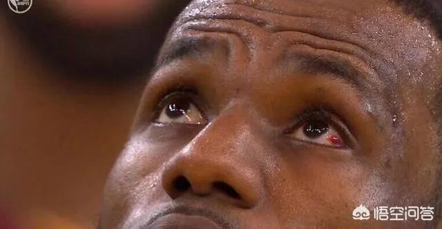 詹姆斯眼睛充血的问题怎么样了？