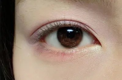 韩式开眼角效果怎样