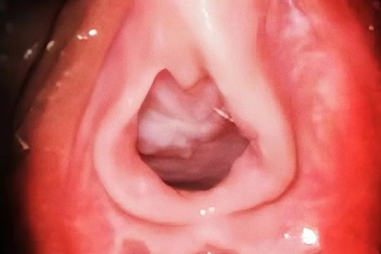 处女膜没有破裂和已经破裂真人对比图