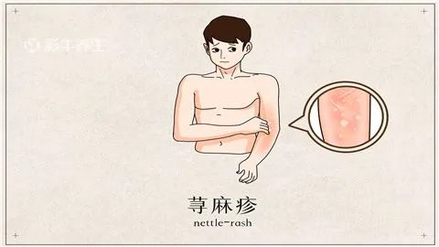 寒冷性荨麻疹治疗