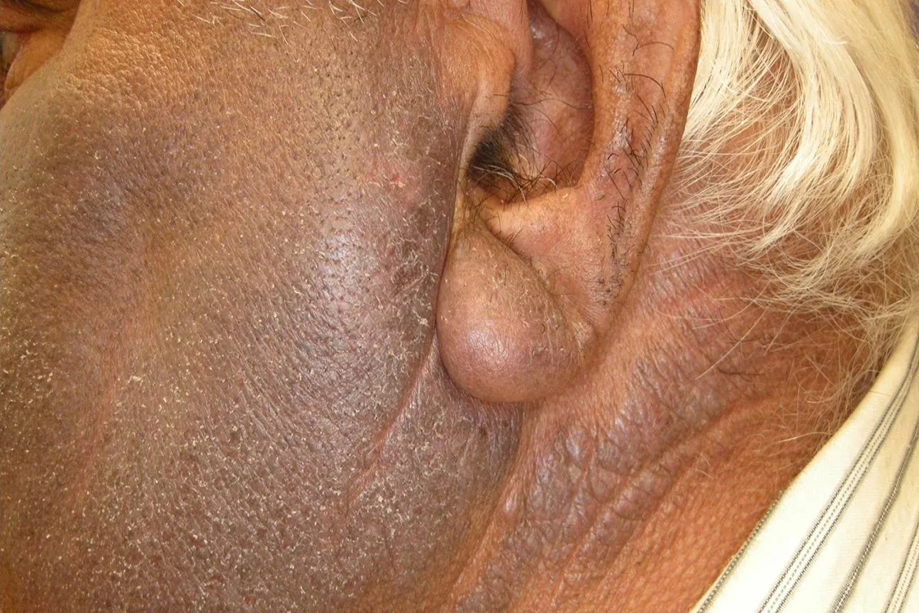 尿毒症面容特征图片