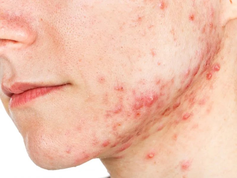 青年痤疮的症状