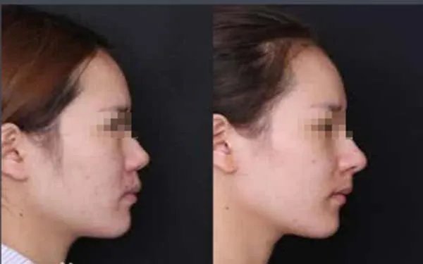 自体软骨隆鼻前后对比