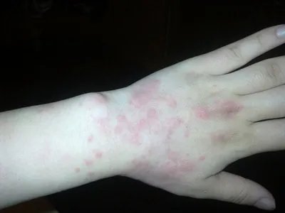 蚋叮咬引起的皮肤反应水疱图片