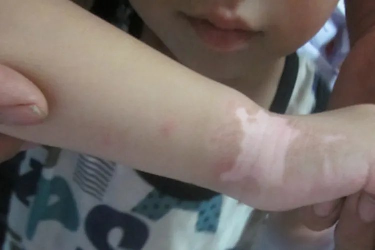 儿童胳膊上有白斑图片大全