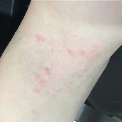 湿疹样皮炎如何治疗?