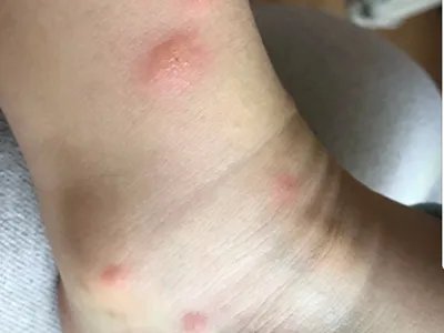 蚋叮咬引起的皮肤反应水疱图片