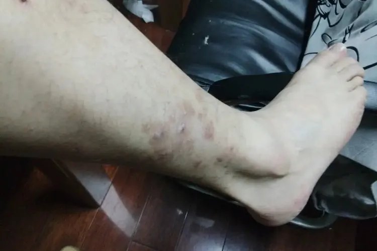 小腿湿疹图片和症状图片
