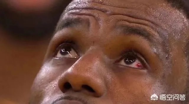 詹姆斯眼睛充血的问题怎么样了？