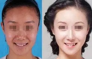 北京激光嫩肤价格