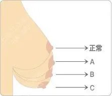 乳房下垂怎样修复效果才会最好呢？