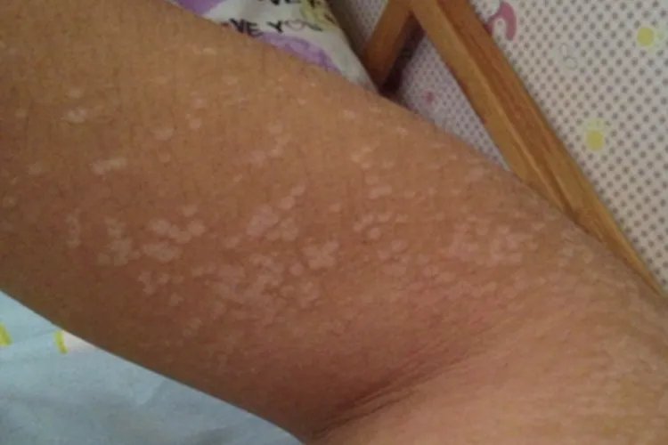 儿童胳膊上有白斑图片大全