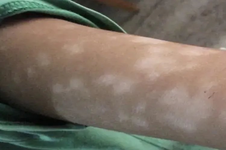 儿童胳膊上有白斑图片大全