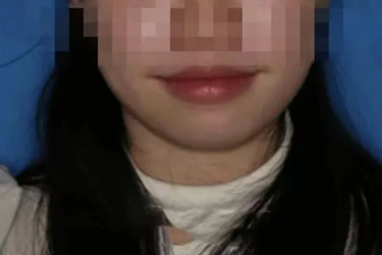 牙齿矫正图片效果图