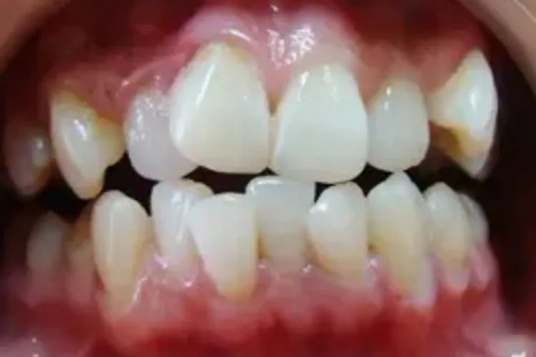 牙齿矫正图片效果图