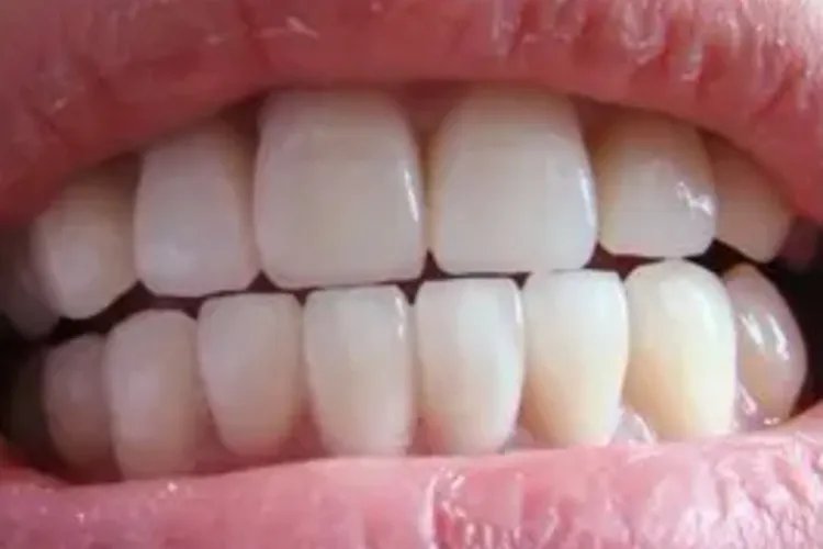 牙齿矫正图片效果图