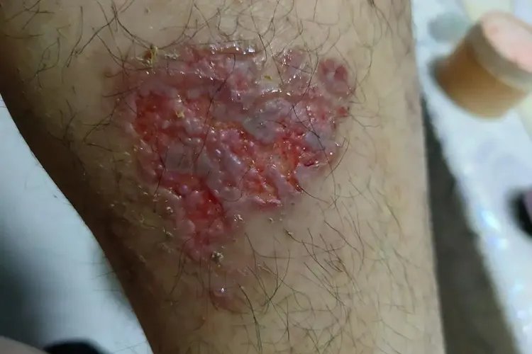 小腿湿疹图片和症状图片