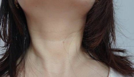 去颈纹多少钱啊