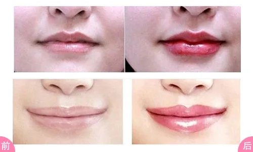 玻尿酸丰唇的效果好吗