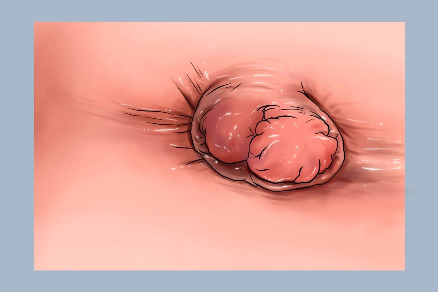 宝宝正常肛门图片与痔疮图片对比