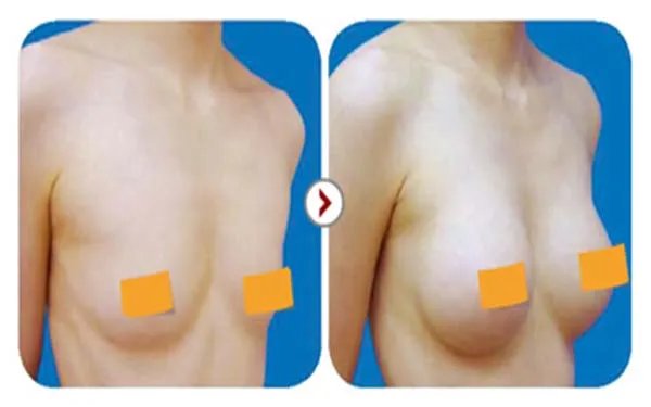 曼托隆胸价格多少钱