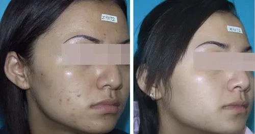 激光美容祛痘多少钱