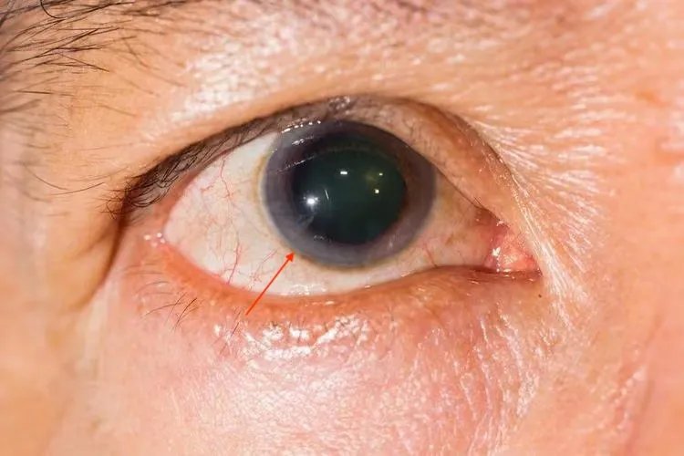 瞳孔散大图片和正常的对比