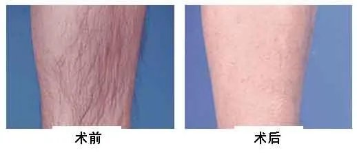 做全身激光脱毛多少钱