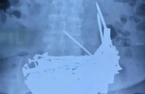 俄罗斯一老太为何会吞下1公斤铁钉？