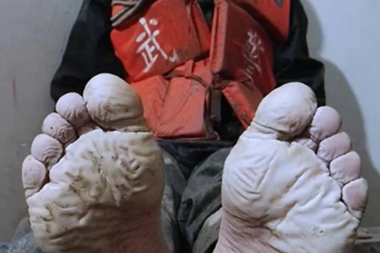 战壕足症状图片