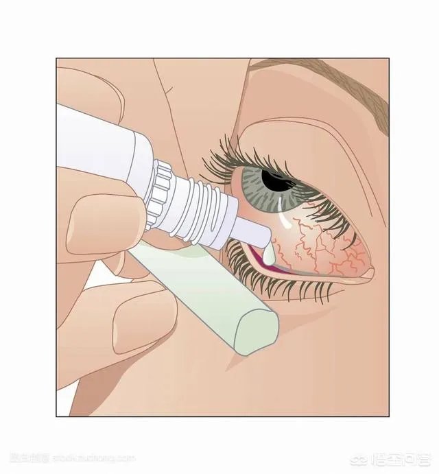 詹姆斯眼睛充血的问题怎么样了？