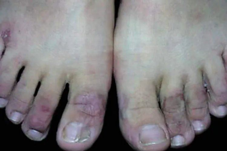 战壕足症状图片