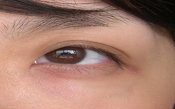 成都去眼袋好的医院是哪家