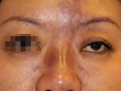 上颌窦癌症状图片