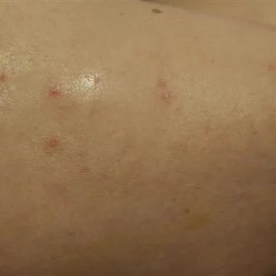 湿疹样皮炎如何治疗?