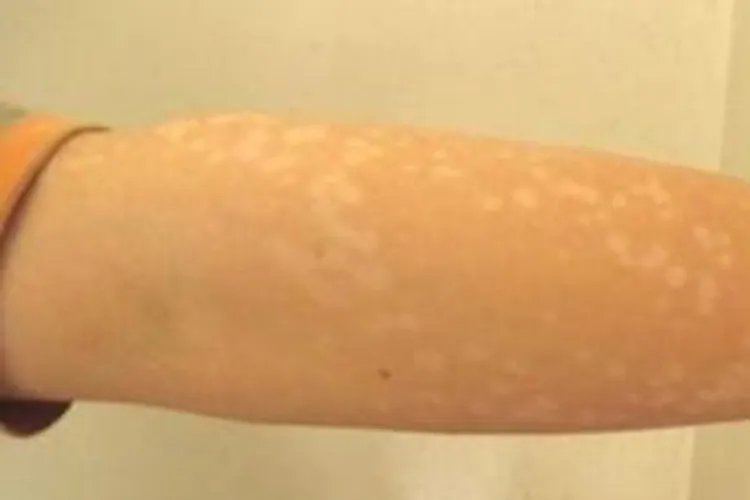 儿童胳膊上有白斑图片大全