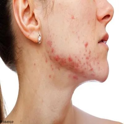 激光治疗痤疮效果怎么样