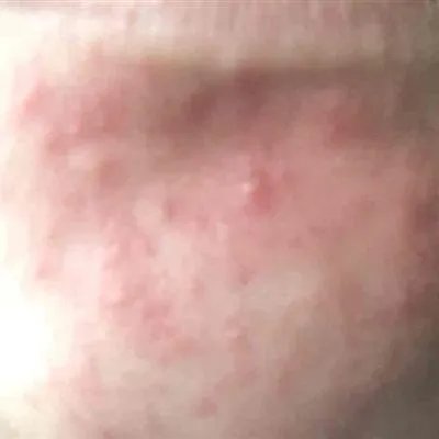 湿疹样皮炎如何治疗?