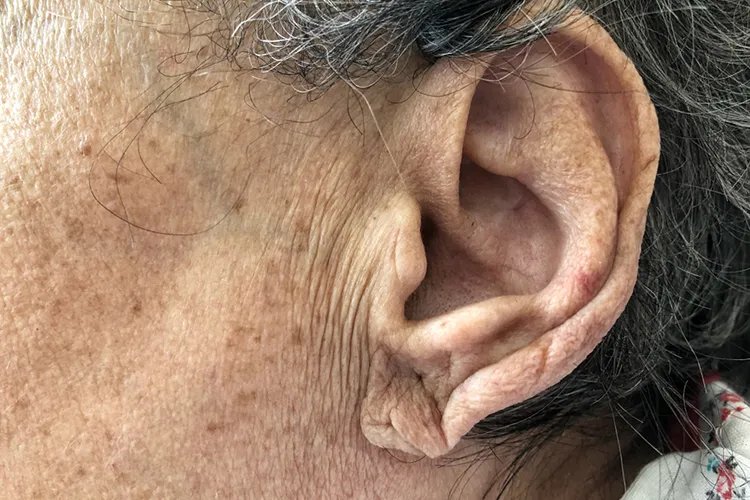 耳垂有一道深横线图片