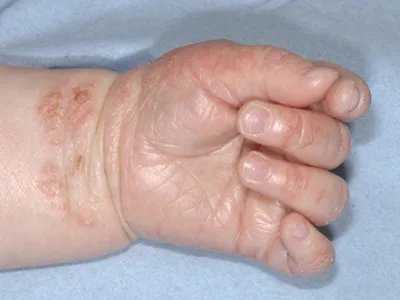 特发性嗜酸性粒细胞增多综合征手腕裂纹图片