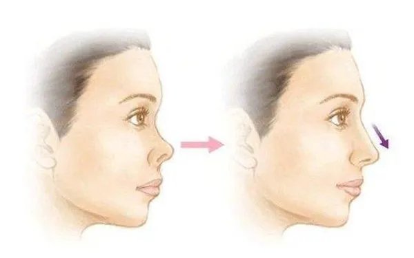 朝天鼻如何整形