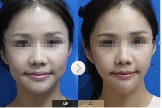 瘦脸针多少钱一次