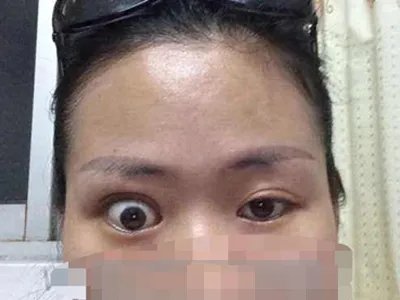 上颌窦癌症状图片